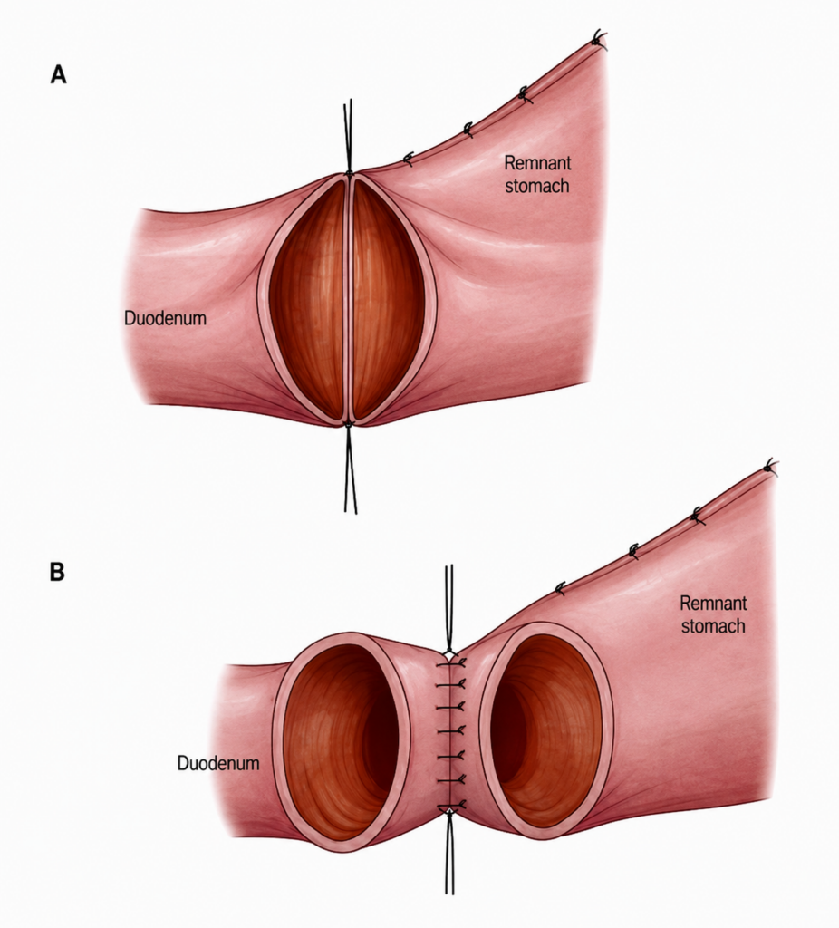 Distal Gastrectomy with Billroth I Reconstruction 2