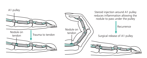 Trigger Finger Surgery: A Practical Step-by-Step Guide for Operating Room Nurses Trigger Finger Surgery: A Practical Step-by-Step Guide for Operating Room Nurses
