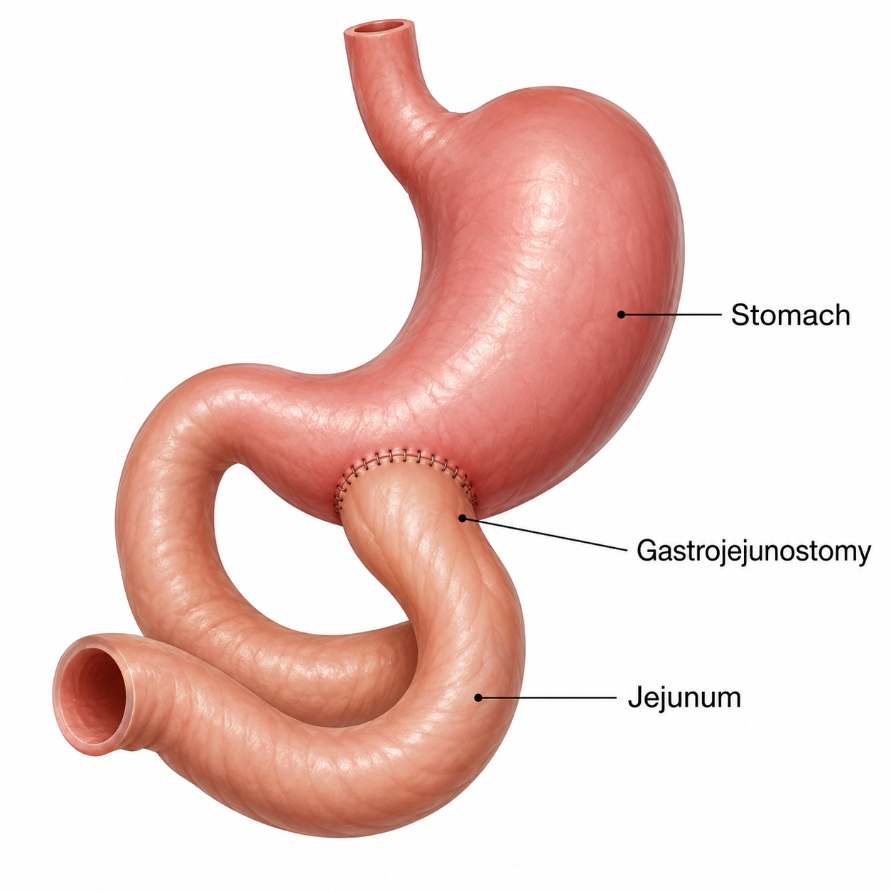 Gastrojejunostomy (GJ): Complete Operating Room Guide for Surgical Nurses Gastrojejunostomy (GJ): Complete Operating Room Guide for Surgical Nurses