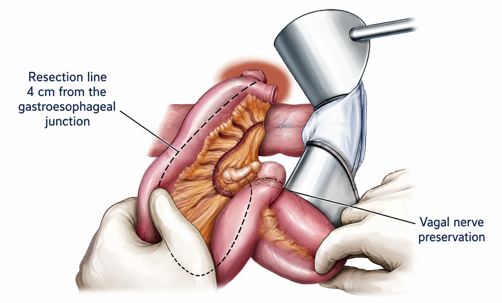 Total Gastrectomy: Surgical Procedure, Lymph Node Dissection, and Roux-en-Y Reconstruction Total Gastrectomy: Surgical Procedure, Lymph Node Dissection, and Roux-en-Y Reconstruction