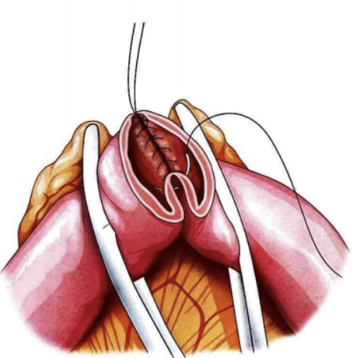 Intestinal Anastomosis 3